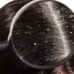 Miksi hilseilyä esiintyy ja miten siitä pääsee eroon? Asiantuntijoiden neuvot